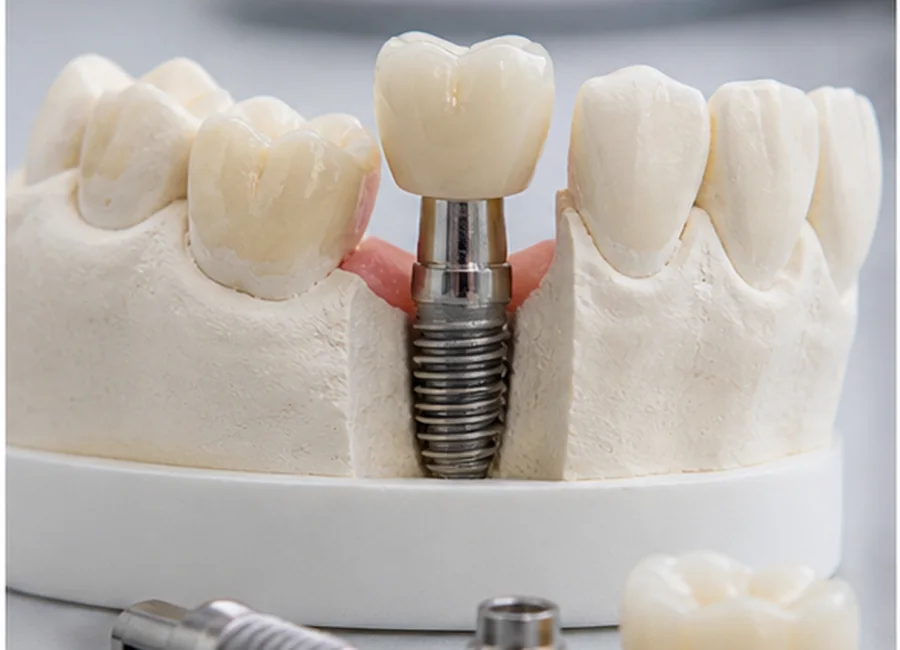 Implant restoration components on a dental model